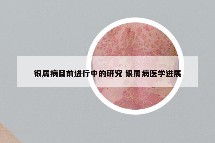银屑病目前进行中的研究 银屑病医学进展