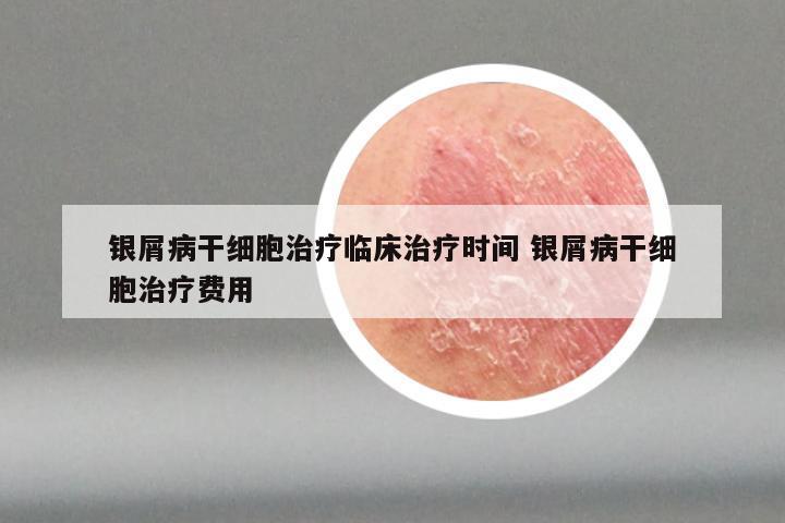 银屑病干细胞治疗临床治疗时间 银屑病干细胞治疗费用