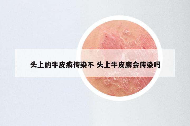 头上的牛皮癣传染不 头上牛皮廨会传染吗