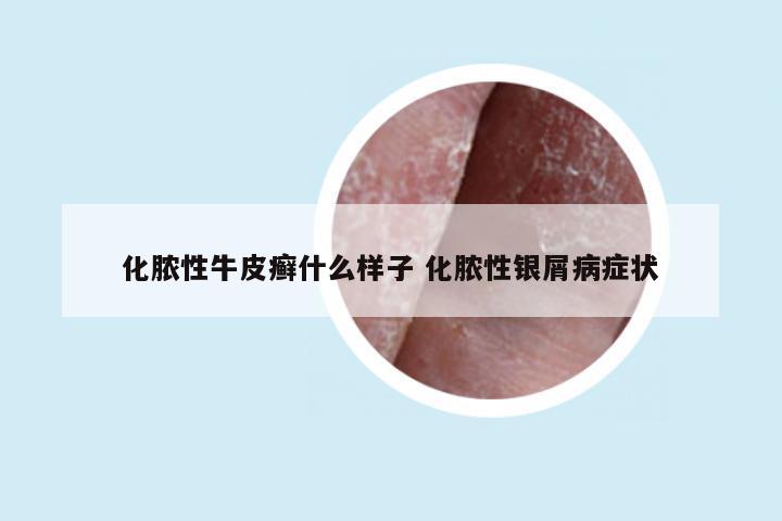 化脓性牛皮癣什么样子 化脓性银屑病症状