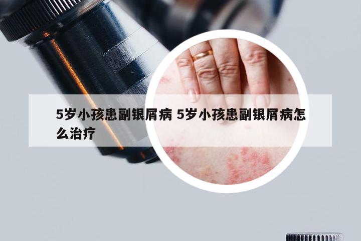 5岁小孩患副银屑病 5岁小孩患副银屑病怎么治疗