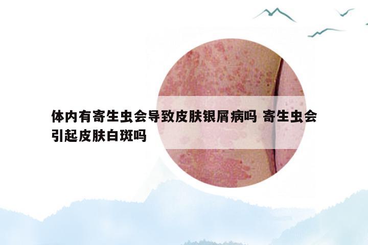 体内有寄生虫会导致皮肤银屑病吗 寄生虫会引起皮肤白斑吗