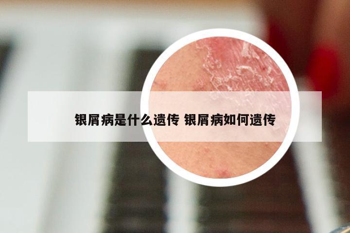 银屑病是什么遗传 银屑病如何遗传