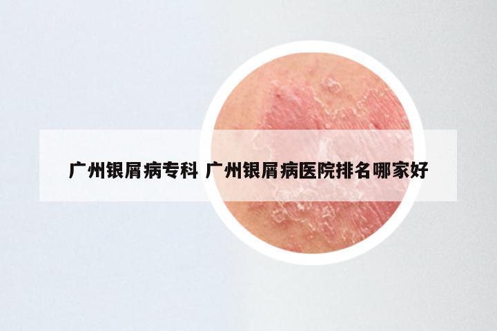 广州银屑病专科 广州银屑病医院排名哪家好