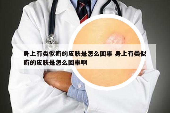 身上有类似癣的皮肤是怎么回事 身上有类似癣的皮肤是怎么回事啊