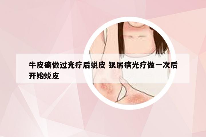 牛皮癣做过光疗后蜕皮 银屑病光疗做一次后开始蜕皮