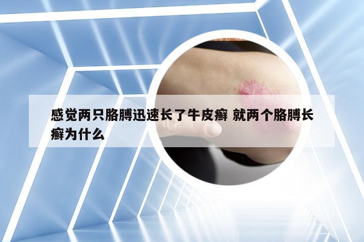 感觉两只胳膊迅速长了牛皮癣 就两个胳膊长癣为什么