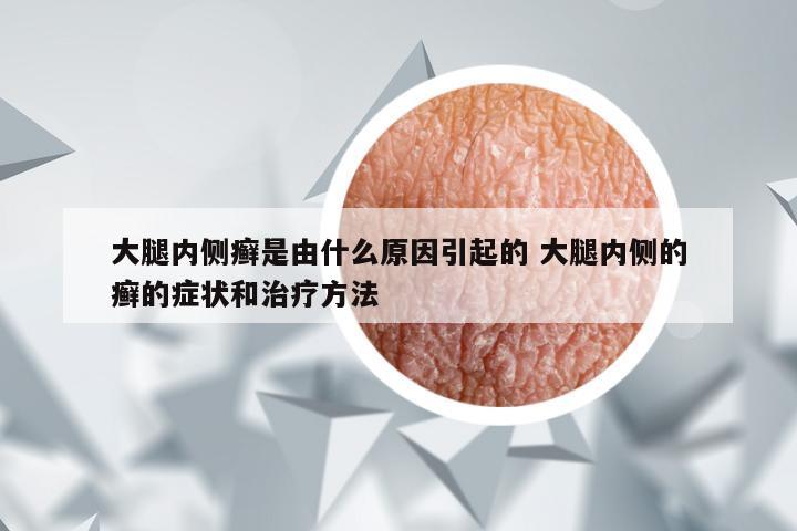 大腿内侧癣是由什么原因引起的 大腿内侧的癣的症状和治疗方法