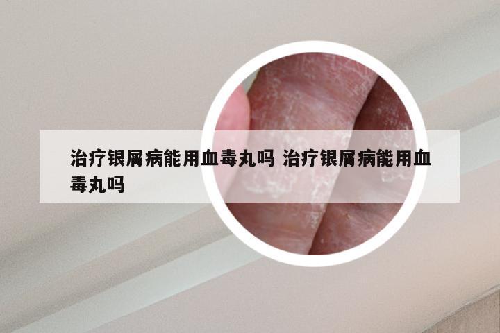 治疗银屑病能用血毒丸吗 治疗银屑病能用血毒丸吗