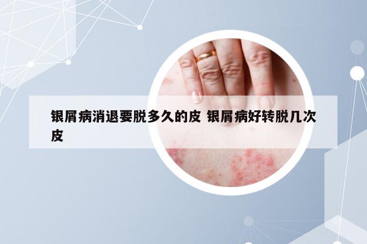 银屑病消退要脱多久的皮 银屑病好转脱几次皮
