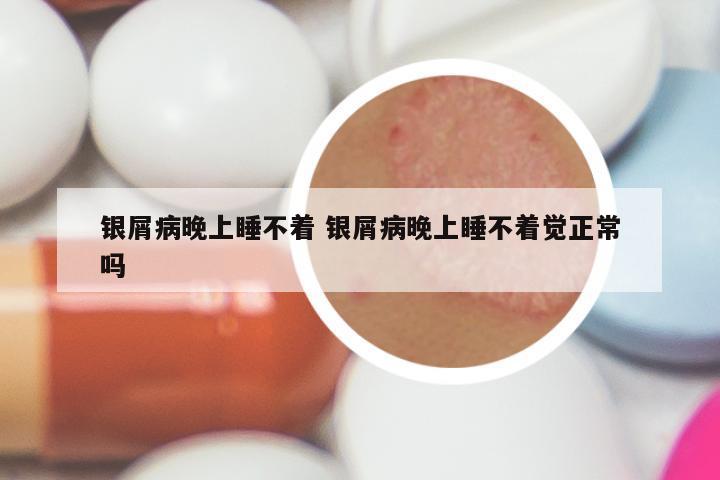 银屑病晚上睡不着 银屑病晚上睡不着觉正常吗