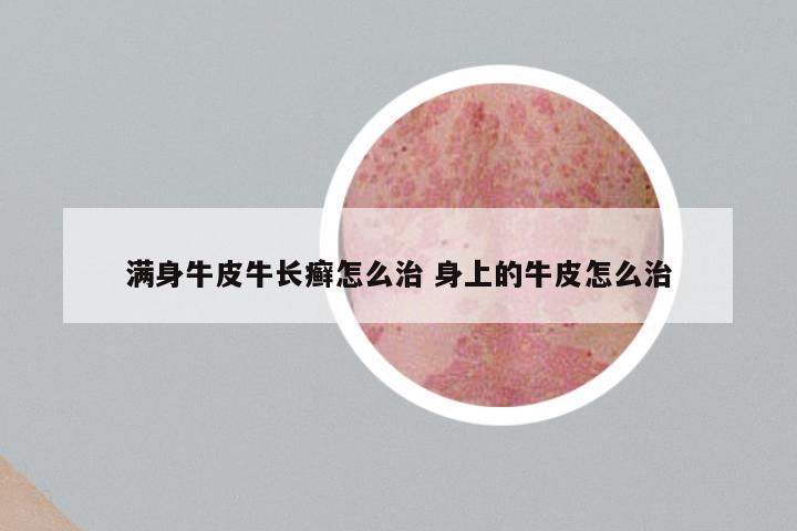 满身牛皮牛长癣怎么治 身上的牛皮怎么治
