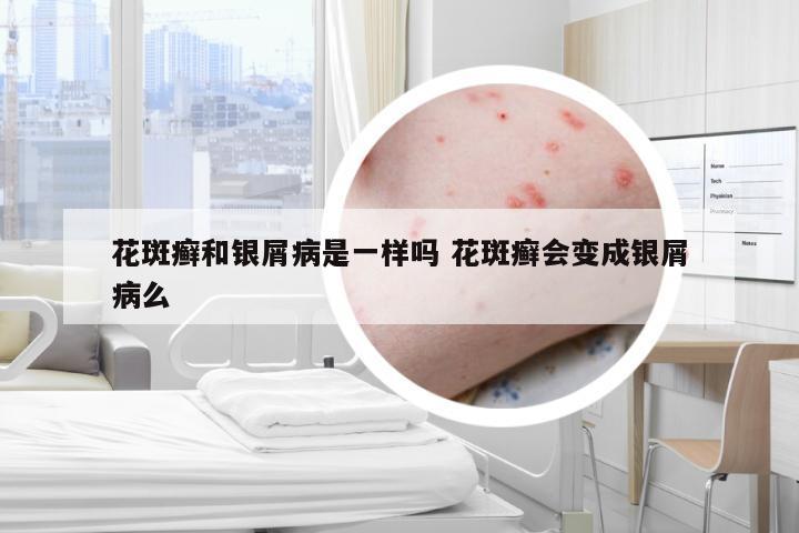 花斑癣和银屑病是一样吗 花斑癣会变成银屑病么
