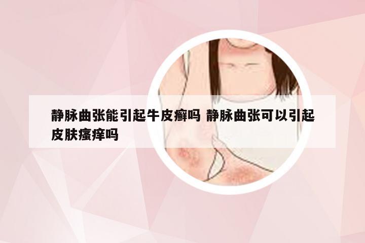 静脉曲张能引起牛皮癣吗 静脉曲张可以引起皮肤瘙痒吗