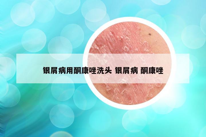 银屑病用酮康唑洗头 银屑病 酮康唑