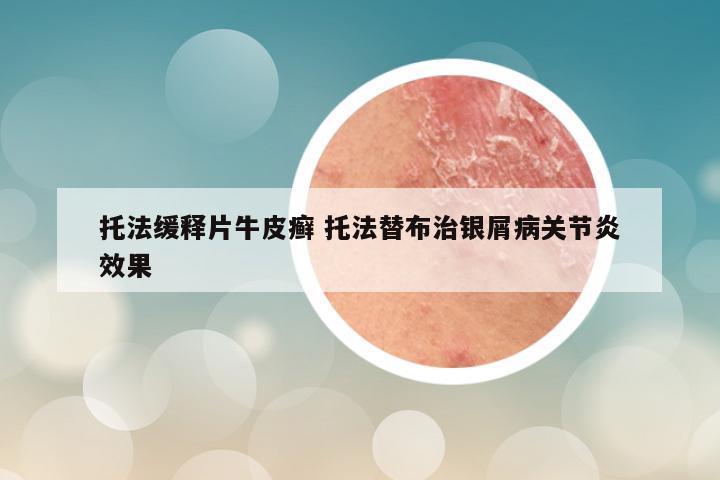 托法缓释片牛皮癣 托法替布治银屑病关节炎效果