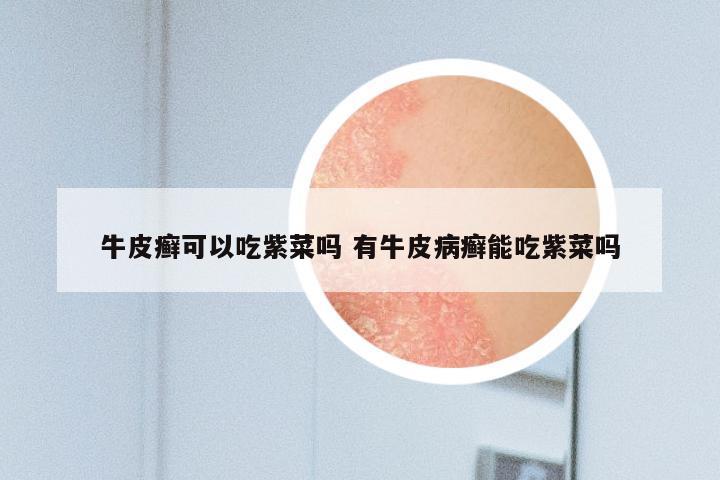 牛皮癣可以吃紫菜吗 有牛皮病癣能吃紫菜吗