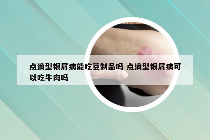 点滴型银屑病能吃豆制品吗 点滴型银屑病可以吃牛肉吗