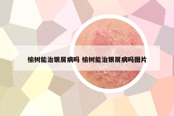 榆树能治银屑病吗 榆树能治银屑病吗图片