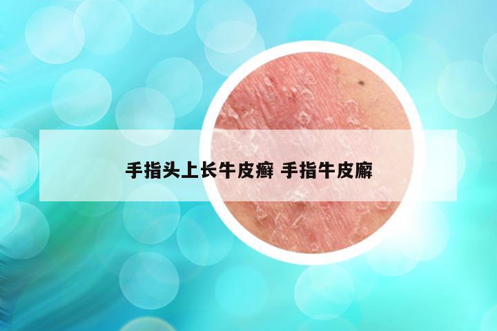 手指头上长牛皮癣 手指牛皮廨