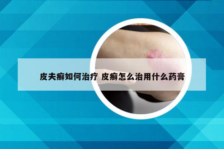 皮夫癣如何治疗 皮癣怎么治用什么药膏