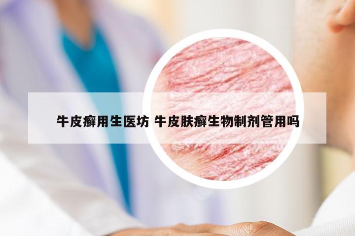 牛皮癣用生医坊 牛皮肤癣生物制剂管用吗