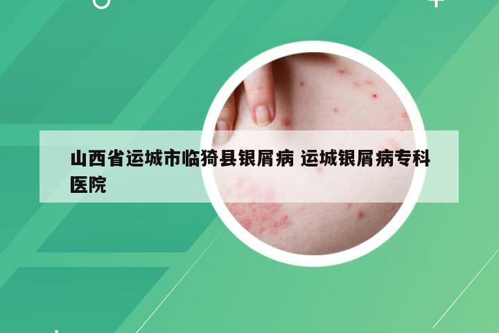 山西省运城市临猗县银屑病 运城银屑病专科医院