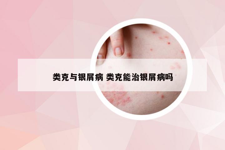 类克与银屑病 类克能治银屑病吗