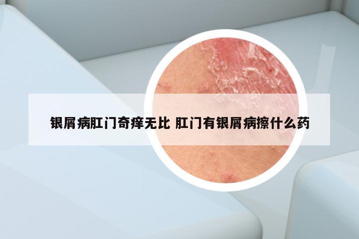 银屑病肛门奇痒无比 肛门有银屑病擦什么药