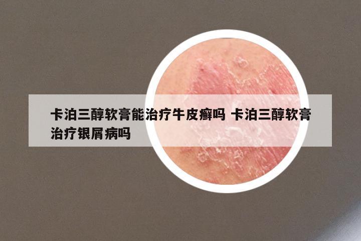 卡泊三醇软膏能治疗牛皮癣吗 卡泊三醇软膏治疗银屑病吗