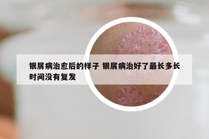 银屑病治愈后的样子 银屑病治好了最长多长时间没有复发