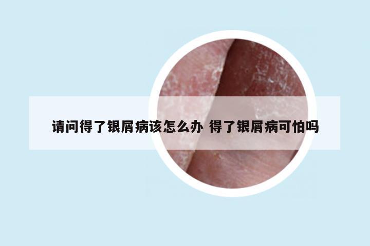 请问得了银屑病该怎么办 得了银屑病可怕吗