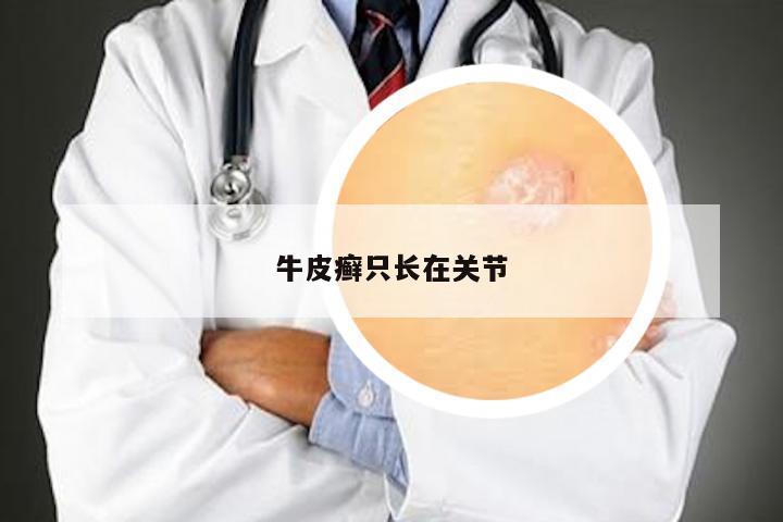 牛皮癣只长在关节