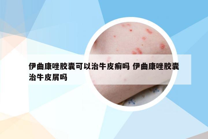 伊曲康唑胶囊可以治牛皮癣吗 伊曲康唑胶囊治牛皮屑吗