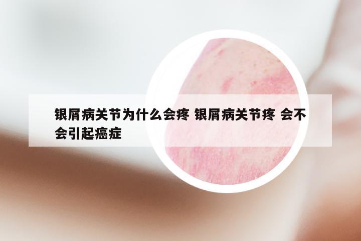 银屑病关节为什么会疼 银屑病关节疼 会不会引起癌症