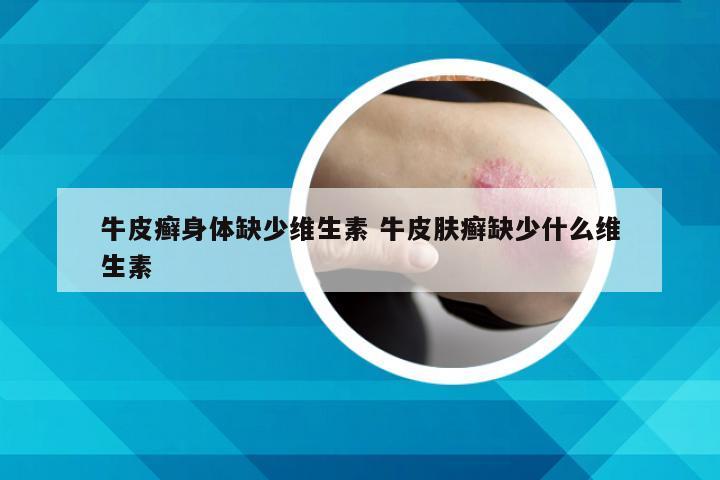 牛皮癣身体缺少维生素 牛皮肤癣缺少什么维生素