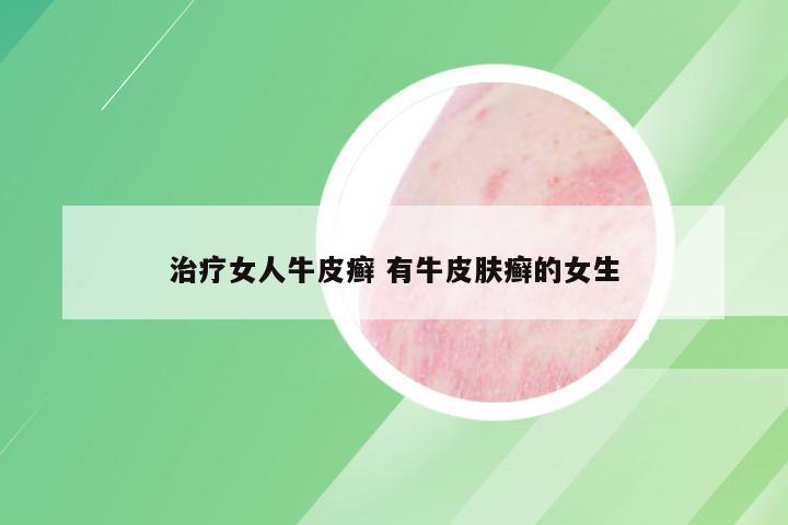 治疗女人牛皮癣 有牛皮肤癣的女生