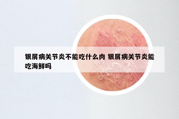 银屑病关节炎不能吃什么肉 银屑病关节炎能吃海鲜吗