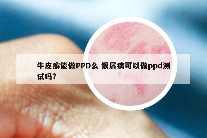 牛皮癣能做PPD么 银屑病可以做ppd测试吗?