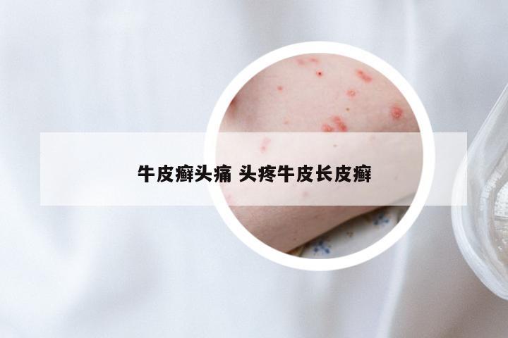 牛皮癣头痛 头疼牛皮长皮癣