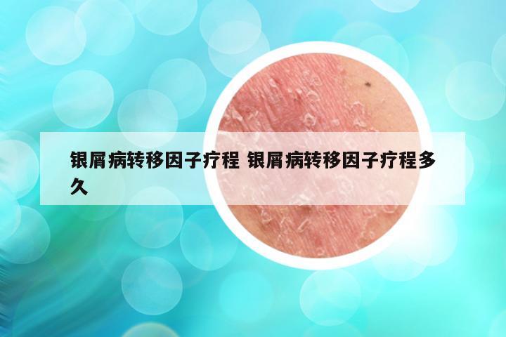 银屑病转移因子疗程 银屑病转移因子疗程多久