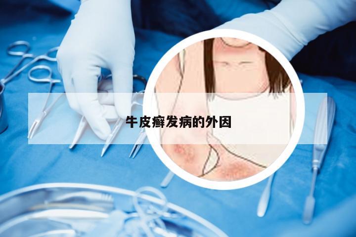 牛皮癣发病的外因