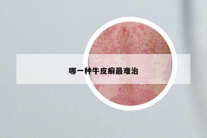 哪一种牛皮癣最难治