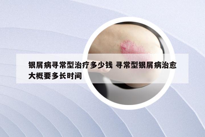 银屑病寻常型治疗多少钱 寻常型银屑病治愈大概要多长时间