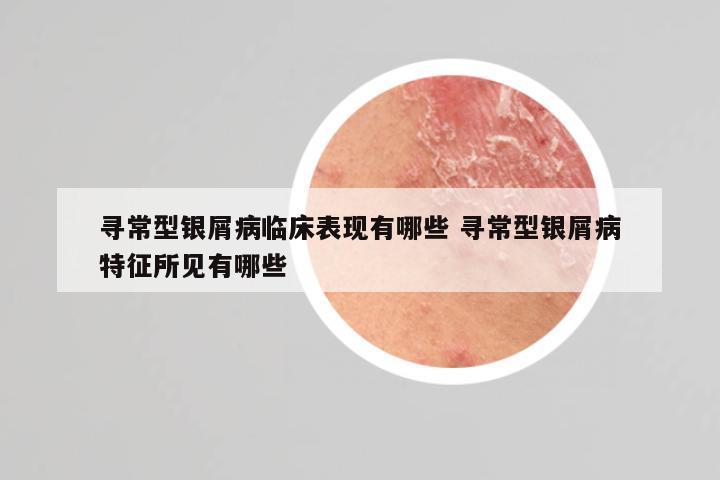 寻常型银屑病临床表现有哪些 寻常型银屑病特征所见有哪些
