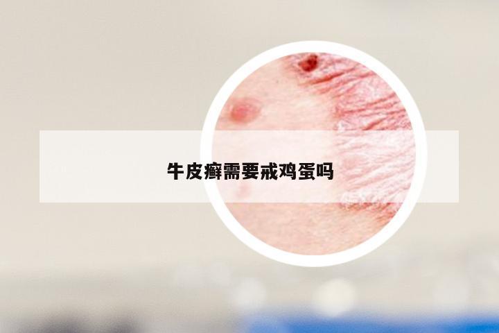 牛皮癣需要戒鸡蛋吗