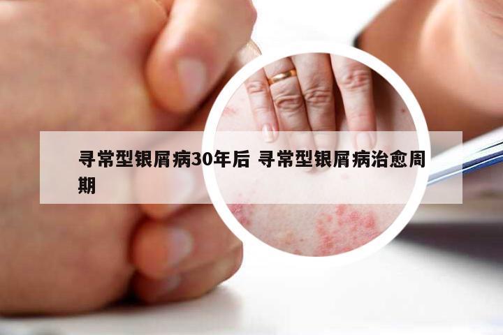 寻常型银屑病30年后 寻常型银屑病治愈周期