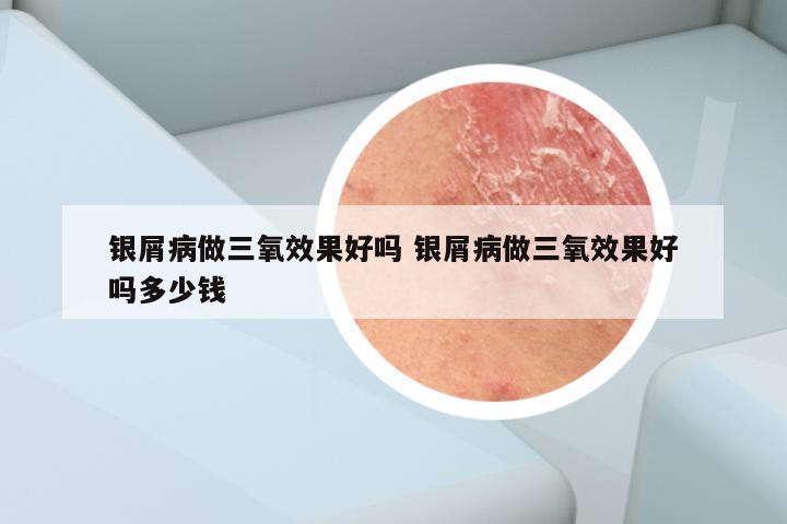 银屑病做三氧效果好吗 银屑病做三氧效果好吗多少钱
