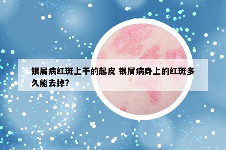 银屑病红斑上干的起皮 银屑病身上的红斑多久能去掉?