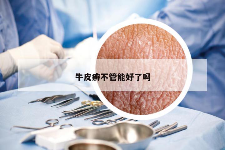 牛皮癣不管能好了吗